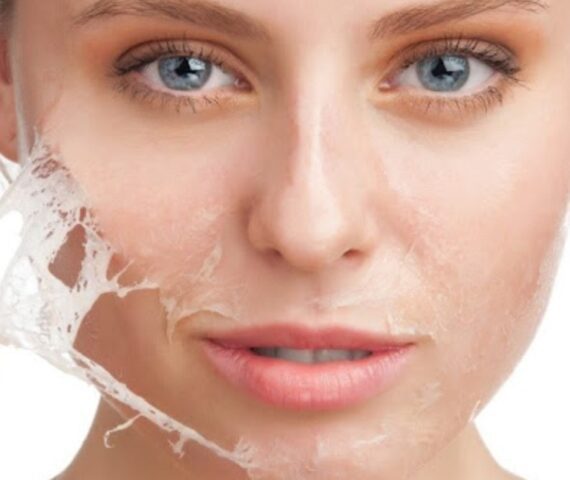 Chăm Sóc Da Sau Peel Hiệu Quả Và An Toàn Nhất