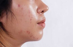 Nguyên Nhân Gây Nên Da Dầu Và Cách Khắc Phục