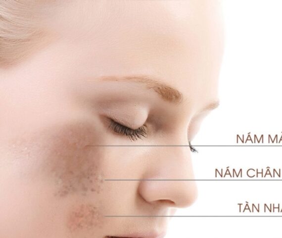 Tìm Hiểu Nguyên Nhân Nám Da Và Tàn Nhang - Bí Quyết Xóa Bỏ Hoàn Toàn