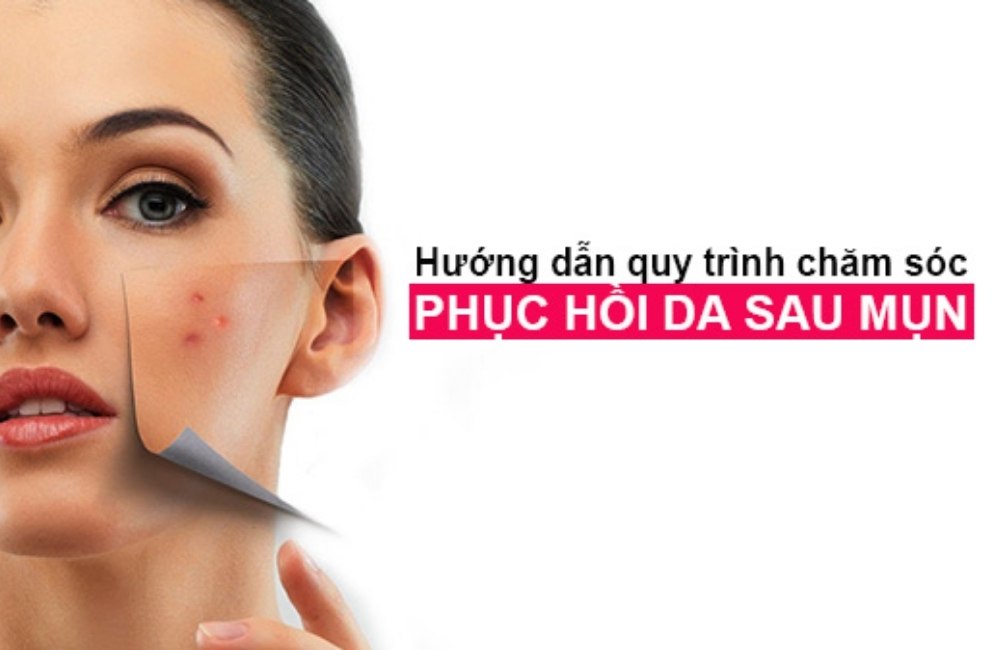 Phục Hồi Da Sau Nặn Mụn Tại Nhà Không Để Lại Thâm Nhanh Chóng