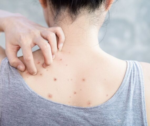 5 Nguyên Nhân Khiến Mọc Mụn Lưng Vào Mùa Hè Này