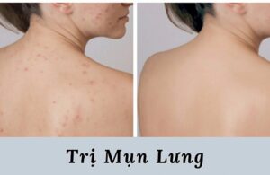 5 Nguyên Nhân Khiến Mọc Mụn Lưng Vào Mùa Hè Này 4 5 Nguyên Nhân Khiến Mọc Mụn Lưng Vào Mùa Hè Này