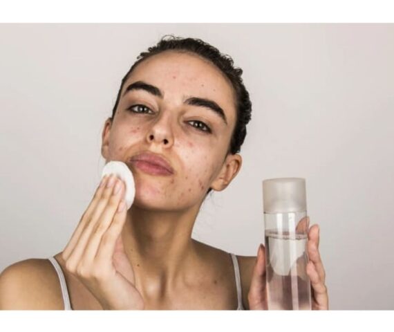 Mẹo Xóa Vết Thâm Mụn Để Lại Chỉ Sau Một Đêm