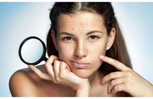 Có Nên Đắp Mặt Nạ Sau Nặn Mụn? Bao Lâu Thì Được Đắp