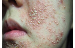 Dấu Hiệu Da Bị Nhiễm Corticoid - Nguyên Nhân Và Cách Điều Trị 3 Dấu Hiệu Da Bị Nhiễm Corticoid - Nguyên Nhân Và Cách Điều Trị