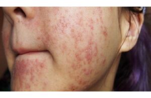 Dấu Hiệu Da Bị Nhiễm Corticoid - Nguyên Nhân Và Cách Điều Trị 5 Dấu Hiệu Da Bị Nhiễm Corticoid - Nguyên Nhân Và Cách Điều Trị