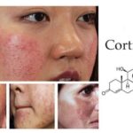 Dấu Hiệu Da Bị Nhiễm Corticoid - Nguyên Nhân Và Cách Điều Trị
