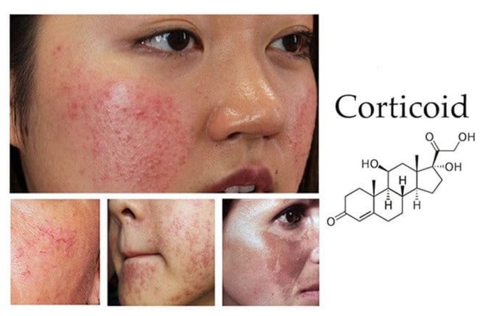 Dấu Hiệu Da Bị Nhiễm Corticoid - Nguyên Nhân Và Cách Điều Trị