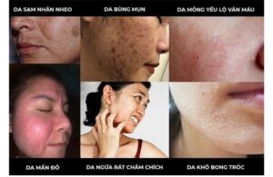Dấu Hiệu Da Bị Nhiễm Corticoid - Nguyên Nhân Và Cách Điều Trị 4 Dấu Hiệu Da Bị Nhiễm Corticoid - Nguyên Nhân Và Cách Điều Trị