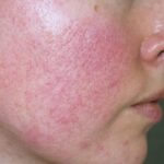 Đột Nhiên Da Mỏng Đi Và Lộ Mao Mạch, Nguyên Nhân Do Đâu?