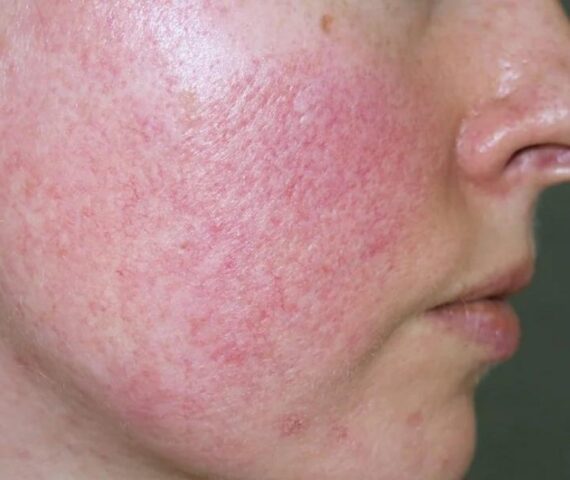 Đột Nhiên Da Mỏng Đi Và Lộ Mao Mạch, Nguyên Nhân Do Đâu?