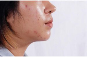 5 Cách Giảm Tiết Dầu Trên Da Mặt Hiệu Quả Tại Nhà