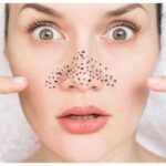 6 Cách Đánh Bay Mụn Đầu Đen Trên Mũi Hiệu Quả Có Thể Làm Tại Nhà
