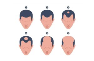 Rụng Tóc Trên Đỉnh Đầu Có Trị Được Không? Nguyên Nhân Và Cách Đặc Trị 2 Rụng Tóc Trên Đỉnh Đầu Có Trị Được Không? Nguyên Nhân Và Cách Đặc Trị