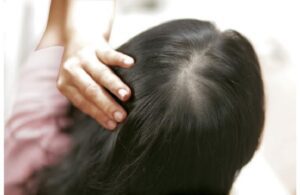 Rụng Tóc Trên Đỉnh Đầu Có Trị Được Không? Nguyên Nhân Và Cách Đặc Trị