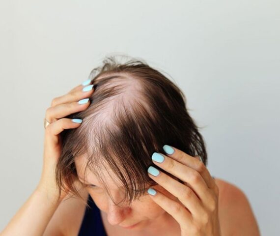 Rụng Tóc Trên Đỉnh Đầu Có Trị Được Không? Nguyên Nhân Và Cách Đặc Trị