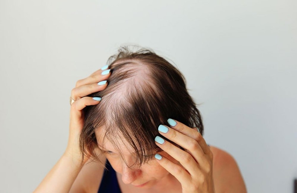 Rụng Tóc Trên Đỉnh Đầu Có Trị Được Không? Nguyên Nhân Và Cách Đặc Trị