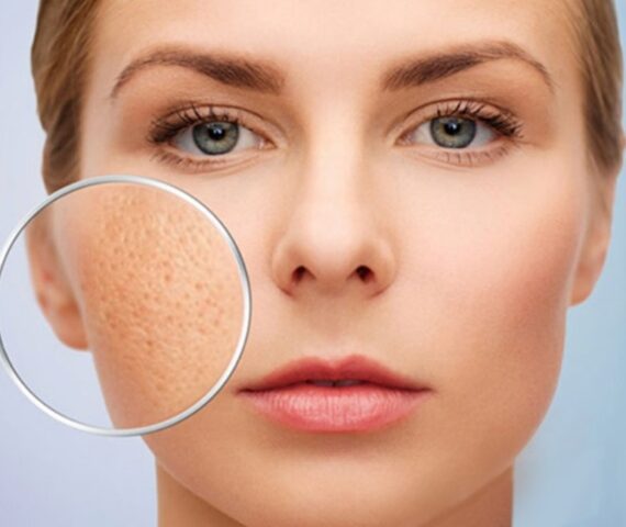 Sẹo Do Mụn Để Lại Có Hết Được Không? Cách Xử Lý Nhanh Nhất Ngừa Sẹo