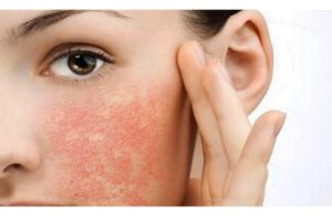 Mất Bao Lâu Thì Da Cháy Nắng Nhả Được Nắng? Phục Hồi Như Ban Đầu 2 Mất Bao Lâu Thì Da Cháy Nắng Nhả Được Nắng? Phục Hồi Như Ban Đầu