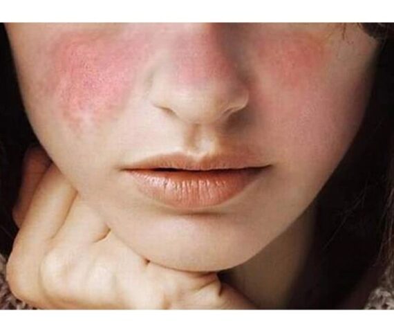 Cách Xử Lý Làn Da Bị Kích Ứng Do Mỹ Phẩm Cấp Tốc