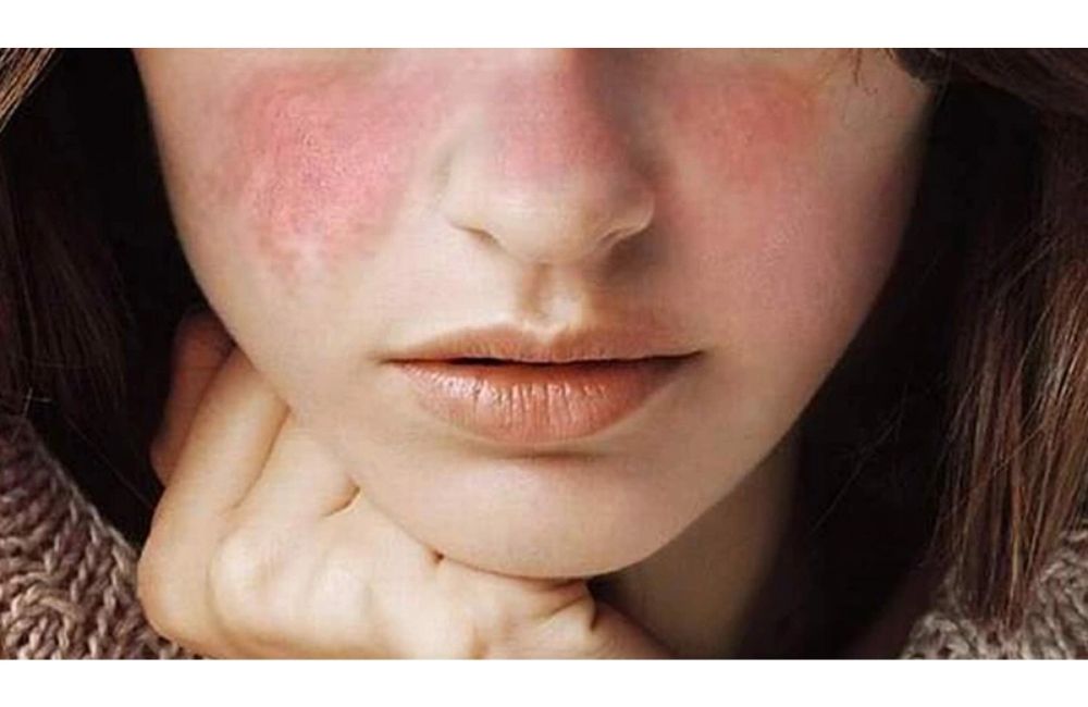 Cách Xử Lý Làn Da Bị Kích Ứng Do Mỹ Phẩm Cấp Tốc