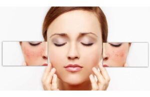 Cách Xử Lý Làn Da Bị Kích Ứng Do Mỹ Phẩm Cấp Tốc