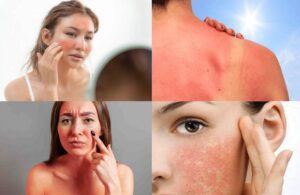 Bật Mí 5 Cách Phục Hồi Làn Da Bị Cháy Nắng 3 Bật Mí 5 Cách Phục Hồi Làn Da Bị Cháy Nắng