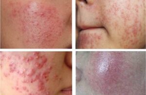 6 Tín Hiệu Cho Thấy Làn Da Đang Kêu Cứu - Thải Độc Cho Làn Da 2 Nhưng Tín Hiệu Cho Thấy Làn Da Đang Kêu Cứu - Thải Độc Cho Làn Da