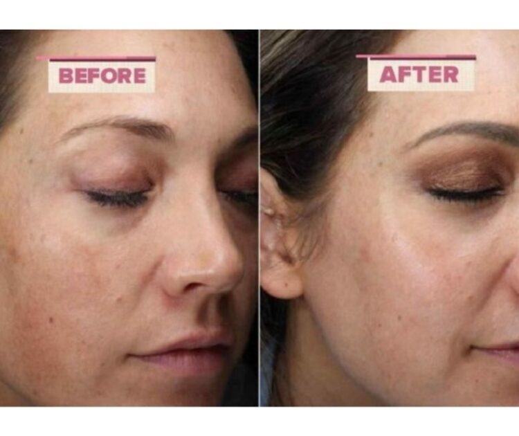 Có Nên Dùng Tretinoin Để Trị Mụn Không? Cách Dùng Đúng Chuẩn
