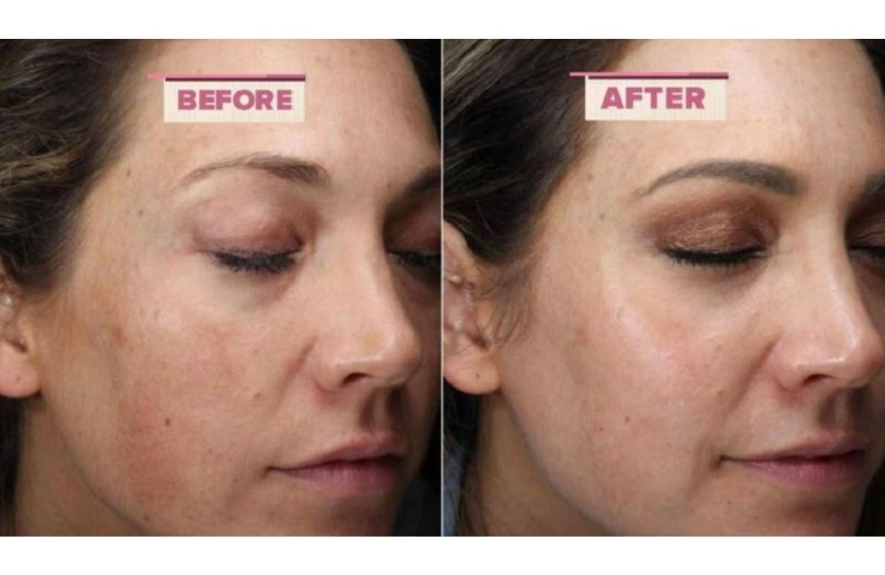 Có Nên Dùng Tretinoin Để Trị Mụn Không? Cách Dùng Đúng Chuẩn