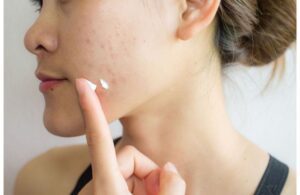 Có Nên Dùng Tretinoin Để Trị Mụn Không? Cách Dùng Đúng Chuẩn 3 Có Nên Dùng Tretinoin Để Trị Mụn Không? Cách Dùng Đúng Chuẩn