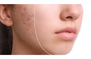 Có Nên Dùng Tretinoin Để Trị Mụn Không? Cách Dùng Đúng Chuẩn 4 Có Nên Dùng Tretinoin Để Trị Mụn Không? Cách Dùng Đúng Chuẩn