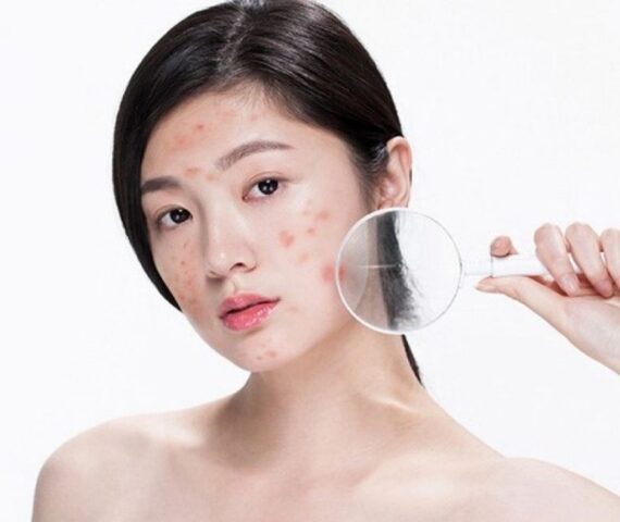 Mụn Có Tự Biến Mất? Quá Trình Trị Mụn Đúng Cách An Toàn Cho Làn Da