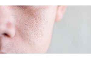 Nguyên Nhân Hình Thành Sẹo Rỗ Trên Mặt Và Cách Phục Hồi 2 Nguyên Nhân Hình Thành Sẹo Rỗ Trên Mặt Và Cách Phục Hồi