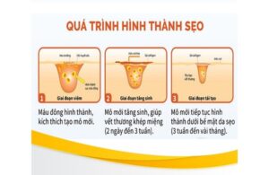 Nguyên Nhân Hình Thành Sẹo Rỗ Trên Mặt Và Cách Phục Hồi 3 Nguyên Nhân Hình Thành Sẹo Rỗ Trên Mặt Và Cách Phục Hồi