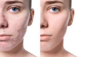 Nguyên Nhân Hình Thành Sẹo Rỗ Trên Mặt Và Cách Phục Hồi 4 Nguyên Nhân Hình Thành Sẹo Rỗ Trên Mặt Và Cách Phục Hồi