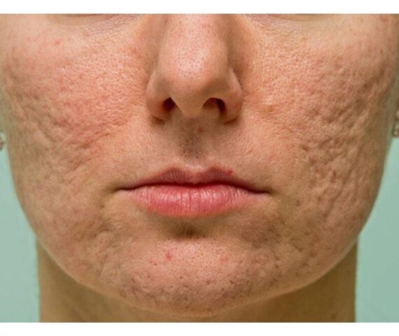 Nguyên Nhân Hình Thành Sẹo Rỗ Trên Mặt Và Cách Phục Hồi