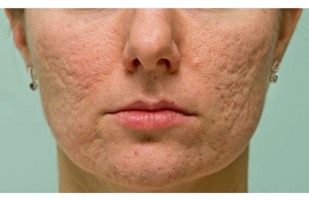 Nguyên Nhân Hình Thành Sẹo Rỗ Trên Mặt Và Cách Phục Hồi 1 Nguyên Nhân Hình Thành Sẹo Rỗ Trên Mặt Và Cách Phục Hồi