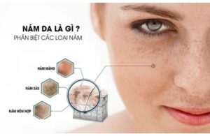Phân Biệt Các Loại Nám Và Cách Điều Trị Nám Hiệu Quả