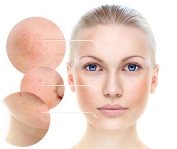 Phân Biệt Các Loại Nám Và Cách Điều Trị Nám Hiệu Quả