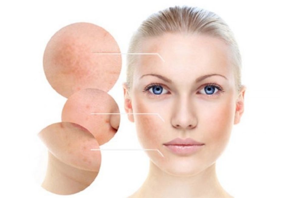 Phân Biệt Các Loại Nám Và Cách Điều Trị Nám Hiệu Quả