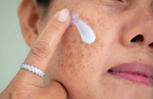 Phân Biệt Các Loại Nám Và Cách Điều Trị Nám Hiệu Quả