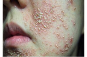Các Tai Hại Khiến Da Bạn Nhiễm Corticoid - Bạn Nên Biết 2 Các Tai Hại Khiến Da Bạn Nhiễm Corticoid - Bạn Nên Biết