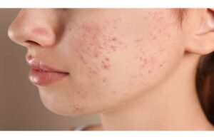 Các Tai Hại Khiến Da Bạn Nhiễm Corticoid - Bạn Nên Biết