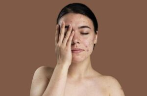 Các Tai Hại Khiến Da Bạn Nhiễm Corticoid - Bạn Nên Biết