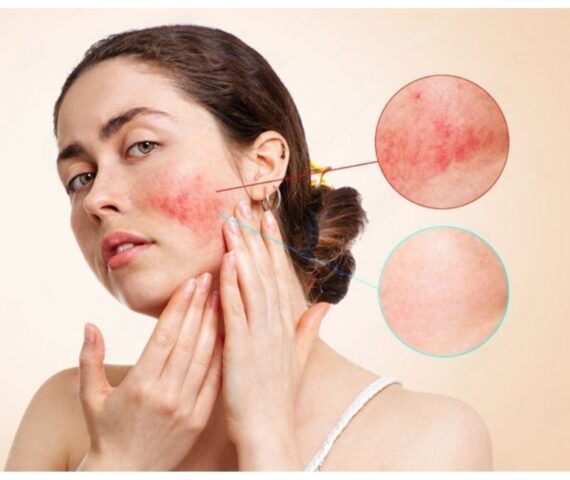 Các Tai Hại Khiến Da Bạn Nhiễm Corticoid - Bạn Nên Biết