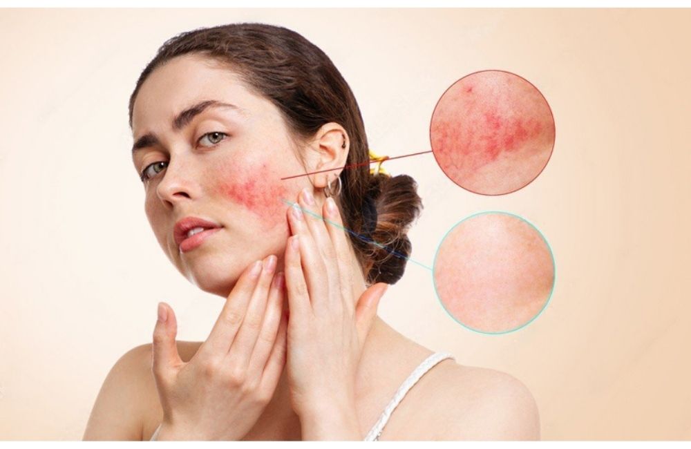 Các Tai Hại Khiến Da Bạn Nhiễm Corticoid - Bạn Nên Biết