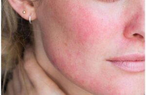 Retinol Nên Bôi Trên Nền Da Khô Hay Ẩm? Cách Bôi Đúng Chuẩn
