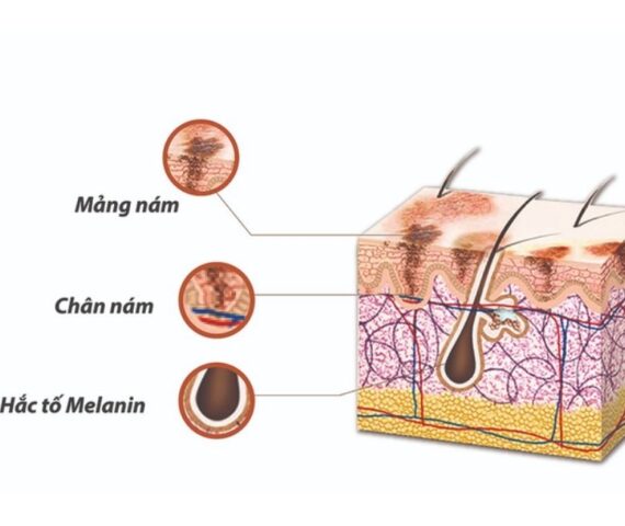 Nám Da Từ Đâu Mà Có? Cách Tránh Các Tác Nhân Hình Thành Nám