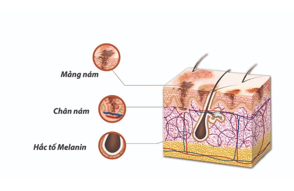 Nám Da Từ Đâu Mà Có? Cách Tránh Các Tác Nhân Hình Thành Nám